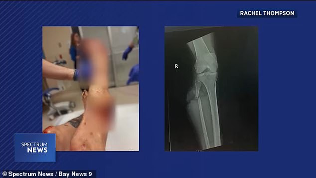 Doctors saw Thompson's leg was in bad shape and were worried about a potential infection