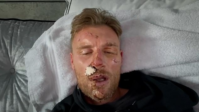 Flintoff flipped a three-wheeled car at Dunsfold Park Aerodrome while filming for Top Gear in December 2022, leaving him with severe injuries as well as debilitating anxiety