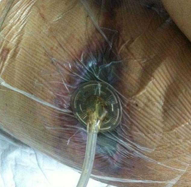 Doctors used a vacuum-like device to drain the abscess after doctors removed layers of dead tissue