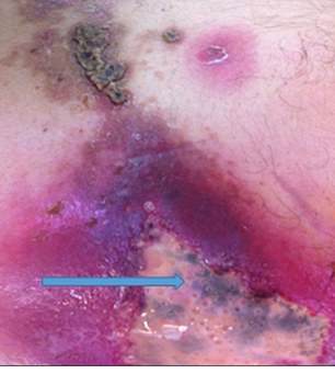 A 55-year-old man presented to the hospital with a severe case of a bacterial flesh-eating infection that had caused a massive sore on his torso