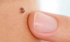 Mole on skin