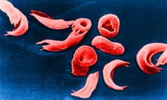 Sickle cell disease changes the shape of blood cells into crescents