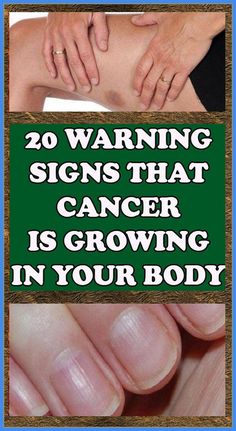 20 Warning Signs that Cancer is Growing in Your Body Alternative Medicine, Natural Remedies For Allergies, Health Habits, Natural Health Remedies, Health Facts, Health And Fitness Tips, Warning Signs, Health Remedies, Health Wellness