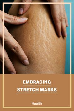 In a world where everyone is saying that stretch marks are beautiful because they created new life, it’s enough to think they’re beautiful because they’re part of your life—your existence.' #bodypositive #mindandbody #selflove Forms Of Birth Control, Complementary Medicine, Being Pregnant, Under My Skin, Bad Memories