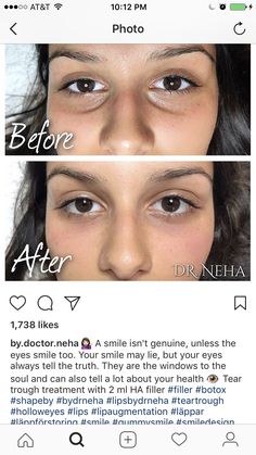 Face Contouring Surgery, Bigger Eyes Surgery, Under Eye Filler Before And After, Under Eye Filler, For Dark Circles Under Eyes, Eye Filler, Face Plastic Surgery, Under Eye Fillers, Rhinoplasty Nose Jobs