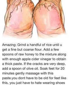 Skin Care Remedies, Dry Cracked Heels, Cracked Heels, Home Health Remedies, Beauty Remedies, Body Skin Care Routine, Diy Skin Care, My Chemical, Beauty Skin Care Routine