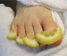 Choppy Hairstyles, Toenail Fungus Remedies, Nail Fungus Remedy, Shaggy Bob, Pedicure At Home, Lemon Slices, Toenail Fungus, Nail Fungus, Nail Health