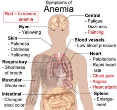 Vitamin Deficiency Anemia Causes, Symptoms, Diagnoses and Treatment Iron Deficiency, Medical Knowledge, Vitamin B12, Chronic Fatigue, The Human Body, Detox Smoothie, Health Info, Health Remedies, Personal Trainer