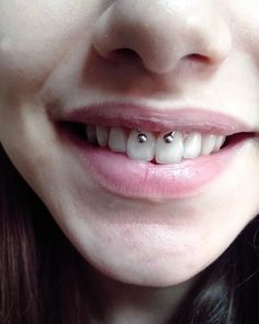 a close up of a person's teeth with braces