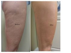 before and after images of varicous on the legs