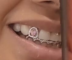 a close up of a person's teeth with braces and a diamond ring