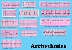 Ekg Interpretation Cheat Sheets, Cardiac Dysrhythmias, Cardiac Arrhythmias, Ekg Interpretation, Cardiac Nursing, Respiratory Therapy, Nursing Tips