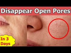 3 Days And All Open Pores Will Disappear From Your Skin Forever - YouTube Open Pores On Face, Open Pores, Pore Strips, Nose Strips, Girl Drawings, Hair Tips Video, Get Rid Of Blackheads, Acne Marks, Enlarged Pores