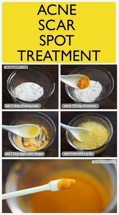 Face Mask Diy Skincare, Laser Acne Scar Removal, Baking Soda Face Mask, Healthy Soda, Acne Laser, Face Mask Diy, Baking Soda Face, Brown Spots On Face, Acne Scar Removal