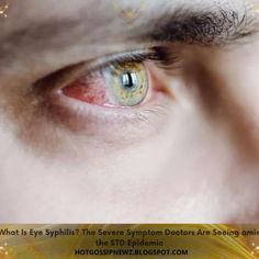 What Is Eye Syphilis? The Severe Symptom Doctors Are Seeing amid the STD Epidemic Eye Pain, Vision Loss, Vision Eye, Light Sensitivity, Pink Eye, Eyes Problems, Bacterial Infection, Pink Eyes