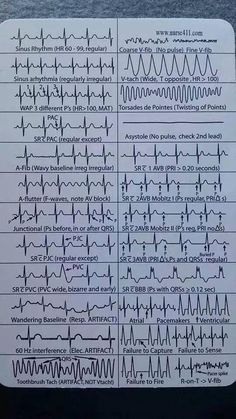 EKG Rhythms Medische Humor, Ekg Rhythms, Cardiac Nursing