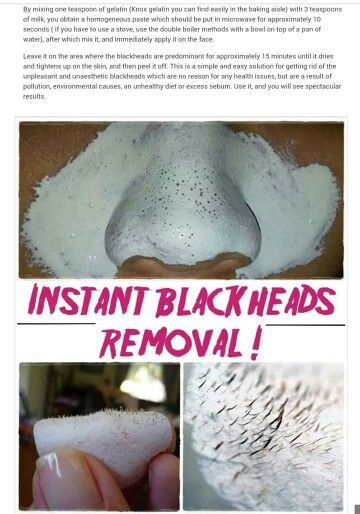 Obličejové Masky, Blackhead Remover Diy, How To Remove Blackheads, To Remove Blackheads, Remove Blackheads, Clear Skin Tips, Homemade Face, Skin Care Solutions, Skincare Tips