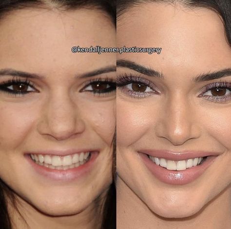 Kendall Jenner Before Surgeries, Kendall Jenner Before And After Surgery, Celebrity Plastic Surgery Before After, Nose Plastic Surgery Before After, Plastic Surgery Before And After, Celebrity Makeup Fails, Plastic Surgery Aesthetic, Face Plastic Surgery, Plastic Surgery Fail