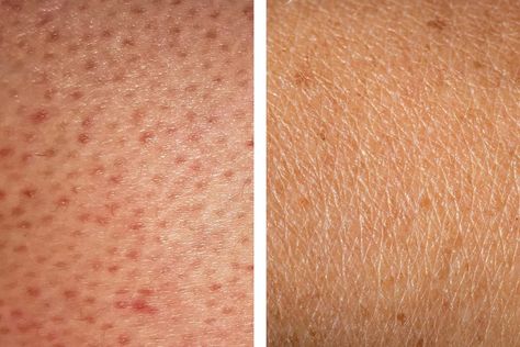 How to Get Rid of Strawberry Legs | Reader's Digest How To Get Rid Of Dots On Legs Skin Care, Flawless Legs Skin, How To Make Legs Look Flawless, Leg Pimples, Red Spots On Legs, Bumps On Legs, Leg Acne, Exfoliate Legs, Shaving Bumps