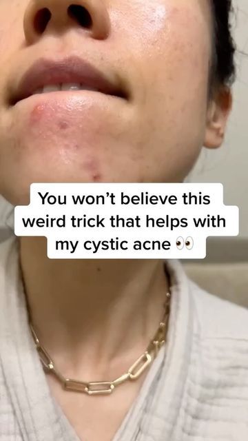 Overnight Acne Remedies Fast, Acne Breakout Remedies, Skincare For Cystic Acne, How To Treat Cystic Acne, How To Make Pimples Go Away Over Night, How To Clear Acne Overnight, How To Treat Hormonal Acne, How To Get Rid Of Cystic Acne, Slugging Skin