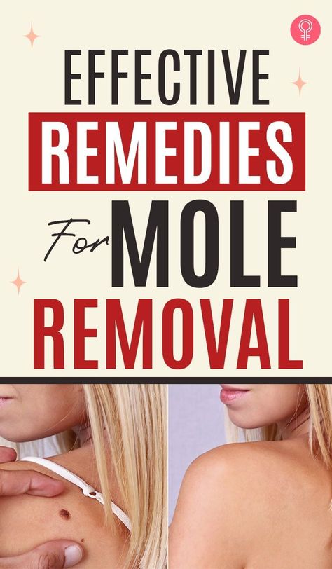 How To Remove A Mole On Face, Getting Rid Of Moles On Skin, Mole Remover Diy, Essential Oils For Moles Removal, Remove Moles At Home, Mole Removal Before And After, Get Rid Of Moles On Skin, Removing Moles Naturally, How To Get Rid Of A Mole