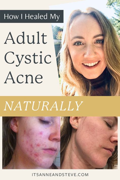 How I Cleared My Adult Cystic Acne Naturally By Trusting My Body Home Acne Remedies, Natural Remedy For Acne, Acne Elimination Diet, Heal Acne Fast, Foods For Cystic Acne, Deep Acne Remedies, Clyndamiacin For Acne, Acne Inflammation Remedies, Best Foods For Hormonal Acne
