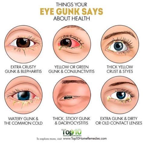 things your eye gunk says about your health Eye Health Facts, Eye Health Remedies, Remedy For Sinus Congestion, Pinkeye Remedies, Home Remedies For Sinus, Eye Facts, Eye Twitching, Healthy Book, Top 10 Home Remedies