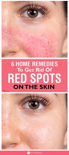 Diy Face Redness Remedy, Skincare For Red Spots, Get Rid Of Facial Redness, Remedies For Redness On Face, Get Rid Of Redness From Pimples, What Helps With Redness On Face, How To Remove Red Spots On Face, Red Veins On Face How To Get Rid, Redness Reducing Skin Care Natural