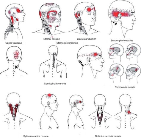 Figure 1 Referred pain patterns from upper trapezius, sternocleidomastoid, suboccipital, splenius capitis, splenius cervicis, semispinalis capitis and temporalis muscle trigger points as described by Simons et al. Reprinted with permission from Simons D, Travell J, Simons L. Travell & Simons myofascial pain and dysfunction: the trigger point manual, Vol. 1, 2nd edn. Baltimore: Williams & Wilkins, 1999. - "Myofascial Trigger Points and Sensitization: An Updated Pain Model for Tension Trigger Points Neck, Lower Limb Muscles, Punkty Spustowe, Headache Medicine, Myofascial Pain Syndrome, Forward Head Posture Exercises, Trigger Point Release, Neck And Shoulder Muscles, Referred Pain