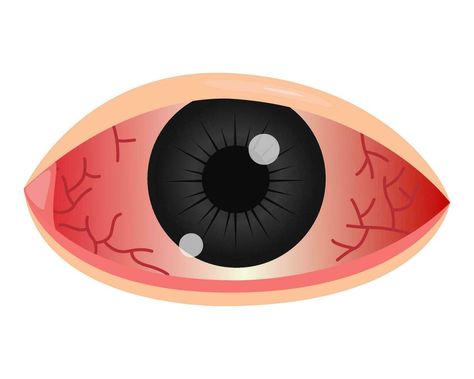 red eye conjunctivitis. vector illustration High Eyes Cartoon, Red High Eyes, Eyes Clipart, Simple Sketches, Eye Illustration, Sore Eyes, Eyes Problems, Red Eye, Sketches Easy