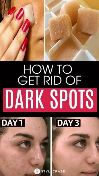 Get Rid Of Dark Spots, Brown Age Spots, Brown Spots On Skin, Acne Dark Spots, Dark Spots On Face, Dark Spots On Skin, Brown Spots Removal, Brown Spots On Face, Skin Spots