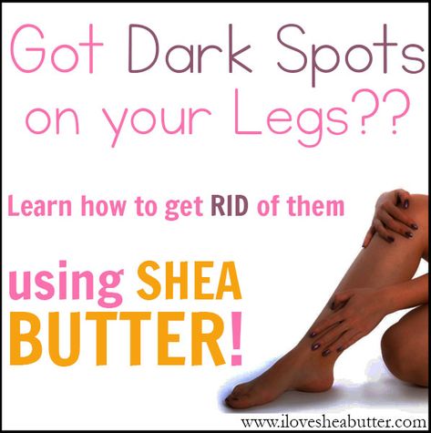 Got Dark Spots on Your Legs? It could be from ingrown hairs, shaving, scars or practically anything out there. Maybe shea butter can help you! Learn how to use it for this particular problem! How To Get Rid Of Dark Spots On Knees, Dark Spots On Legs Remove Diy, Scar Removal Remedies Leg, Ingrown Hair Scars Dark Spots, Blackspot Remedies, How To Remove Dark Spots On Legs Fast, Dark Spots Under Eyes, Dark Spots On Legs, Natural Beauty Hacks