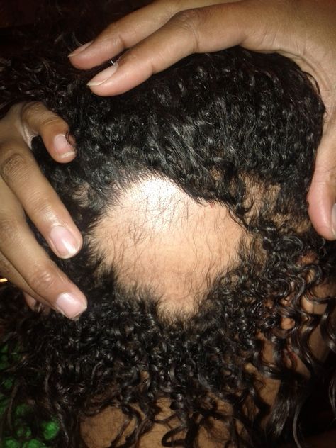 What You Should Do When You Notice A Bald Spot In Your Hair  Read the article here - http://blackhairinformation.com/growth/hair-growth/notice-bald-spot-hair/ Bald Spots Women, Grow Hair Back, Alopecia Hair Growth, Alopecia Hairstyles, Bald Patches, Black Hair Dye, Bald Spot, Hair Growth Shampoo, Bald Hair