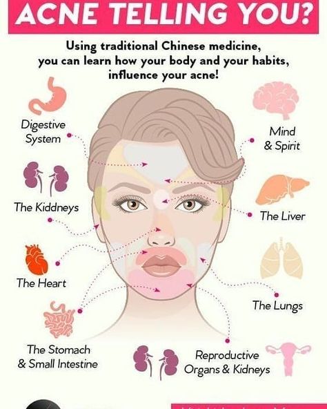 Health, Fitness & Motivation on Instagram: “Did you know??? . . . . #acne #pimple #breakouts #skincare #skin #skincareroutine #homeremedies #natural #organic #antiageing #wrinkle…” Traditional Chinese Medicine, Chinese Face Map, Tcm Traditional Chinese Medicine, Face Mapping Acne, Face Mapping, Face Acne, Alternative Therapies, Acne Skin, Chinese Medicine