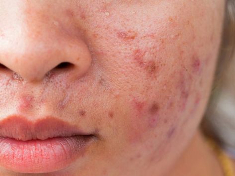 Skin Care Myths, Diy Facial Cleanser, Acne Cleaning, Post Inflammatory Hyperpigmentation, Acne Vulgaris, Natural Acne Remedies, Acne Cream, Natural Cleanser, Acne Breakout