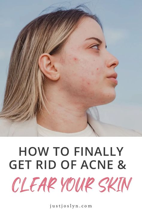 My tried and tested strategies on how to get rid of acne and get clear skin. A skincare routine that actually works to get rid of pimples, prevent breakouts, and skincare tips for acne-prone skin. 😘 how to get rid of breakouts, fine lines in skin, treatments for under eye lines 💋 #glowingskin #anti-inflammatory #wrinkles How To Get Rid Of Cystic Acne Overnight, Ways To Get Rid Of Acne, How To Clear Up Acne, Acne Prone Skin Care Routine, Pimple Solution, Teenage Acne, Acne Medicine, Get Rid Of Pimples, Rid Of Pimples