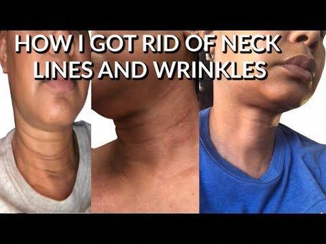 HOW TO GET RID OF NECK WRINKLES AND DARK LINESI'LL SHOW YOU THE TWO PRODUCTS I USED TO GET RID OF THE DARK LINES AND TO FIRM THE SKIN ON MY NECK. I HAD TO L... How To Remove Neck Lines Exercise, Neck Rolls Get Rid Of, Neck Line Remove Exercise, Neck Creases How To Get Rid Of, Tech Neck Lines, How To Reduce Neck Lines, Neck Wrinkles Get Rid Of, Neck Lines Get Rid Of, How To Get Rid Of Neck Lines