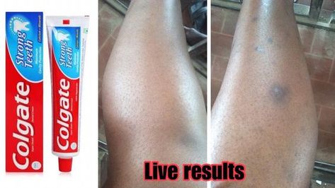 Leg Hyperpigmentation, Leg Scars, Dark Spots On Legs, Get Rid Of Spots, Getting Rid Of Scars, Colgate Toothpaste, How To Fade, Spots On Legs, Dark Spots On Face