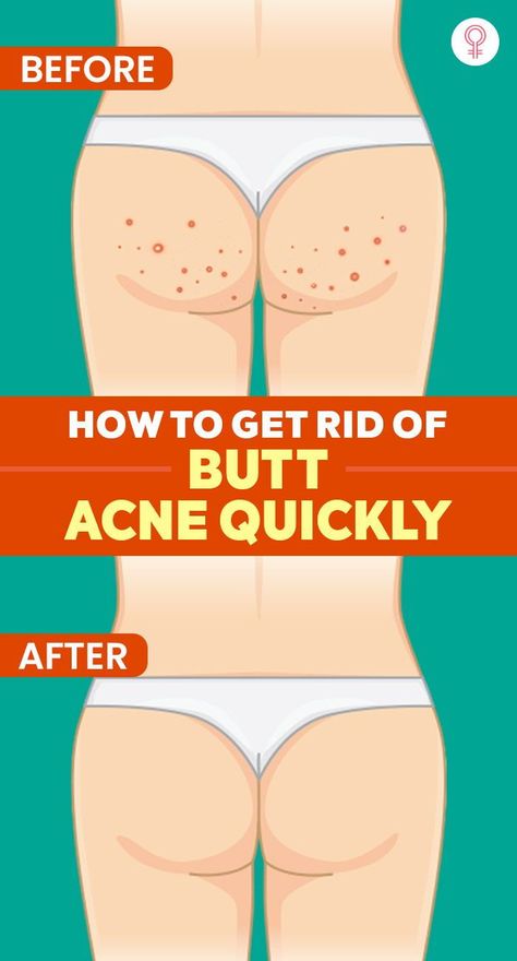 How To Take Care Of My Body Skin, How To Treat Back Acne At Home, Leg Acne Remedies, How To Get Rid Of Hair Down There, How To Get Rid Of Inner Thigh Pimples, Bumpy Skin On Legs How To Get Rid, How To Get Rid Of Acne On Buttocks, How To Get Rid Of Heat Bumps, How To Get Rid Of Closed Comedones At Home