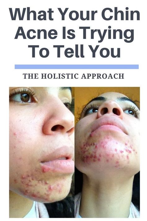 What Your Chin Acne Is Trying To Tell You #acne #pimples #pimplesremedies #acneremedies #skincarediy. https://whispers-in-the-wind.com/combatting-pimples-under-the-skin-expert-tips-and-product-recommendations/?33 Chin Breakouts, Jawline Acne, Chin Acne, Blind Pimple, Prevent Pimples, Pimples Under The Skin, Forehead Acne, Bad Acne, Natural Acne Remedies