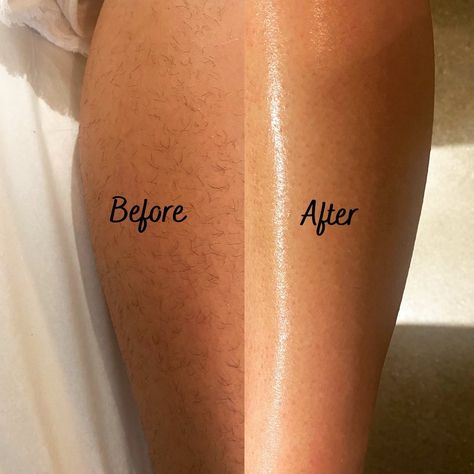 Before & After of waxing 🥰 Laser Hair Removal Men, Female Waxing, Laser Hair Removal Facts, Laser Depilation, Waxing Tips, Hair Removal Spray, Lip Hair Removal, Wax Machine, Upper Lip Hair