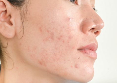 Young woman with acne skin in zoom circle. young girl, beauty portrait. close-up. | Premium Photo Die Off Symptoms, Demodex Mites, Treating Cystic Acne, Facial Scars, Face Scars, Treating Hyperpigmentation, Post Inflammatory Hyperpigmentation, Acne Vulgaris, Acne Breakout