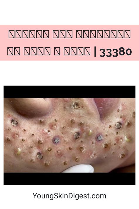 𝐁𝐞𝐚𝐮𝐭𝐲 𝐅𝐨𝐫 𝐄𝐯𝐞𝐫𝐲𝐨𝐧��𝐞 𝐈𝐬 𝐖𝐡𝐚𝐭 𝐈 𝐋𝐢𝐤𝐞 |  33380 Cystic Acne Removal Video, Face Pimples Remedies, Neck Pimples, Acne Popping, Blackheads On Back, Acne Recipes, Huge Blackheads, Acne On Nose, Big Zits