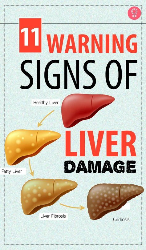 10 Warning Signs Of Liver Damage: whenever there is something wrong with the liver, it displays certain symptoms or warning signs that indicate that it isn’t working properly. Some people experience a sudden weight gain, and even though they try their best, they are unable to lose weight #liverdamage #health #wellness #healthcare Liver Detox, Signs Of Liver Damage, Liver Damage, Liver Diet, Liver Detoxification, Health Signs, Healthy Liver, Liver Health, The Liver