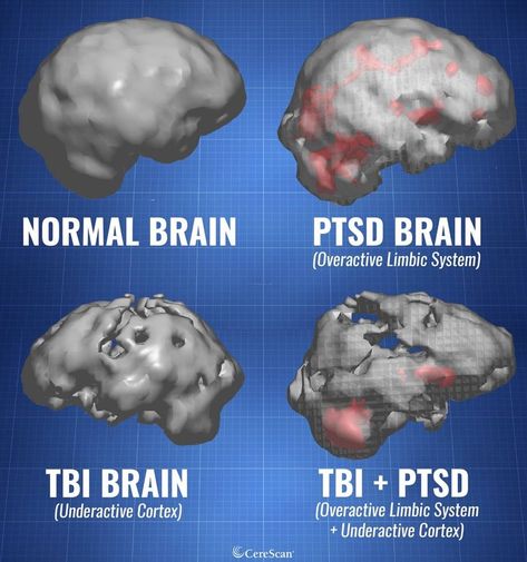 Hyperbaric Oxygen Therapy, Brain Images, Brain Facts, Mental Health Facts, Brain Anatomy, Brain Surgery, Brain Damage, Mental And Emotional Health, Brain Health