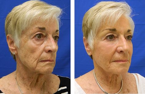 Is Liquid Face Lift Good At Early Age Or Should Be Only Done At Old Age?' Sunken Cheeks, Anti Wrinkle Injections, Hyaluronic Acid Fillers, Facial Anatomy, Tear Trough, Face Change, Aesthetic Medicine, Natural Contour, Layers Of Skin