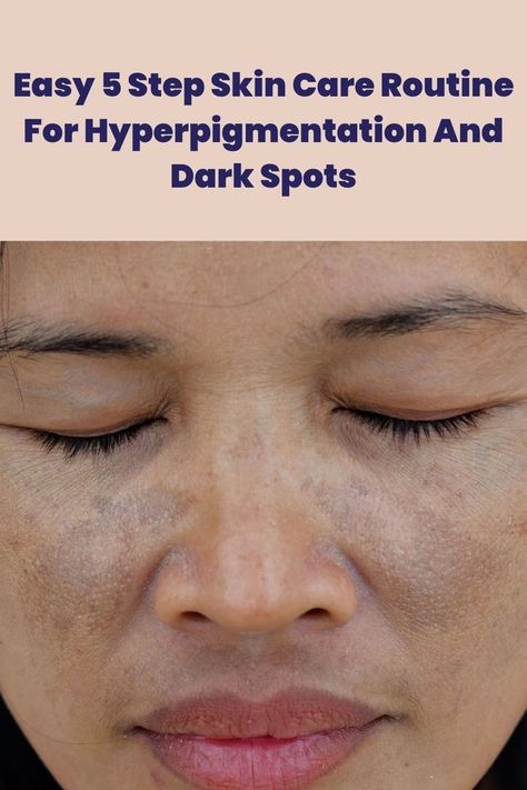 Treating hyperpigmentation became this easy with these 5 skin care steps. Here's how!
#pigmentation #darkspot #skincareroutine #unevenskintone Dark Patches On Face, Skin Care Hyperpigmentation, Treating Hyperpigmentation, Oily Skin Acne, Acne Overnight, Oily Skin Care Routine, Dark Spots On Face, Brown Spots On Face, Spots On Face