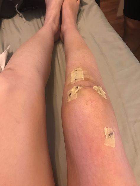 Leg Surgery Snapchat, Bandaged Knee Aesthetic, Knee Wound Fake Story, Leg Wound Fake Story, Skinned Knees Aesthetic, Injury Aethstetic, Scraped Knees Aesthetic, Knee Aesthetic, Knee Injury Snapchat