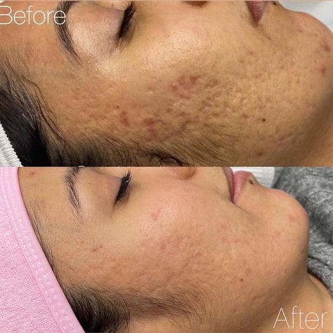 Microdermabrasion for Acne and Acne Scar - Can It Help? Acne Before And After, Microdermabrasion Before And After, Dermabrasion Before And After, Facial Cupping, Derma Pen, Acne Scar, Skin Resurfacing, Acne Marks, Prevent Acne