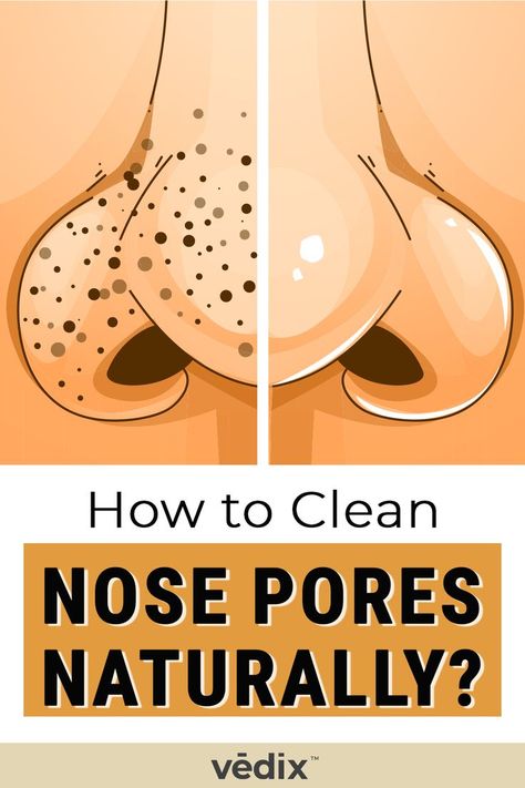 nose pores Clean Nose Pores, Blind Pimple, Remove Body Hair Permanently, Prevent Pimples, Pimples Under The Skin, Nose Pores, Blackheads On Nose, Clean Blackheads, How To Get Rid Of Pimples